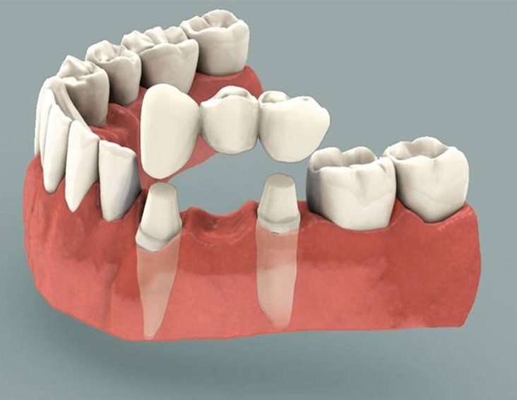 dental-bridge-basic-info-732x566